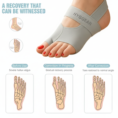 Corrector de juanetes Hyggear (dedo gordo del pie, Hallux Valgus) - 22979067572